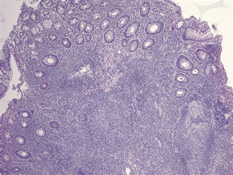 Cureus A Rare Case Of Diffuse Nodular Lymphoid Hyperplasia With