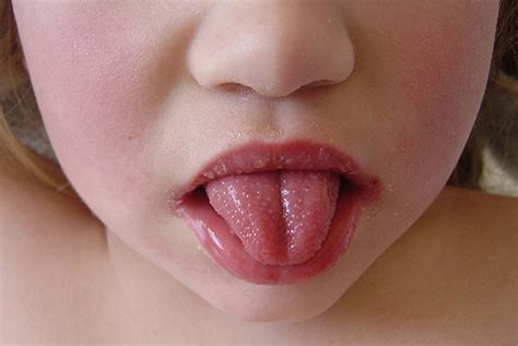 Scarlet Fever Cases Surge To More Than Twice Seasonal