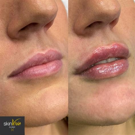 Lip Fillers What You Need To Know Clinician SkinViva Clinic