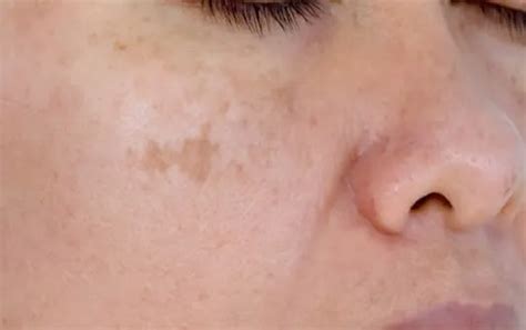Age Spots Vs Sun Spots Whats The Difference Bakersfield Dermatologist