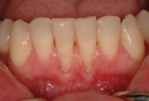 Gum Regeneration Institute Of Dental Implants And Periodontics