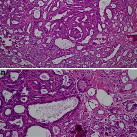 ×20 Photomicrographs Of Sclerosing Adenosis A Large Central Area Of