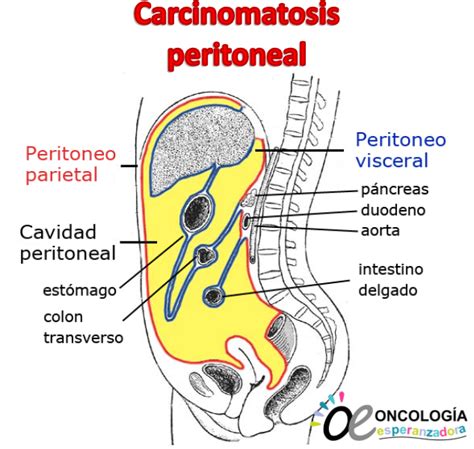 Carcinomatosis Peritoneal Oncología Esperanzadora