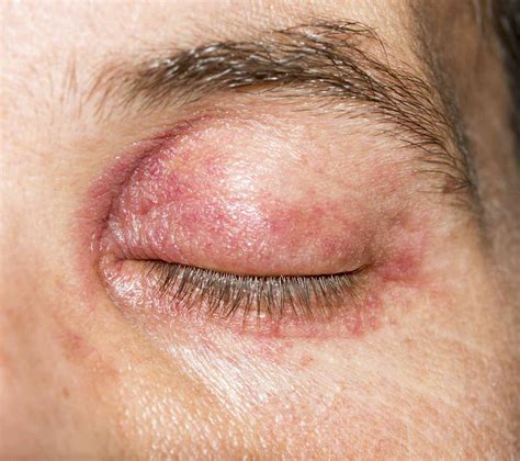 Eyelid Dermatitis Eczema Causes Treatment And More