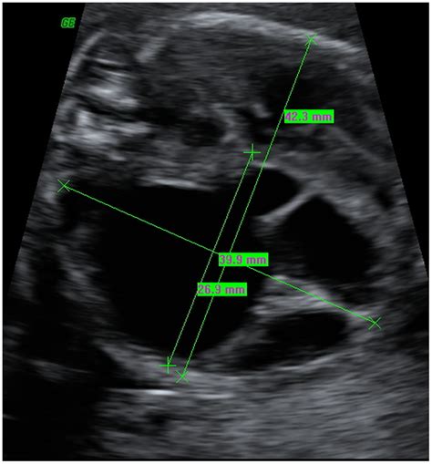 Transverse Section Of The Fetal Thorax At 19 Weeks Of Gestation