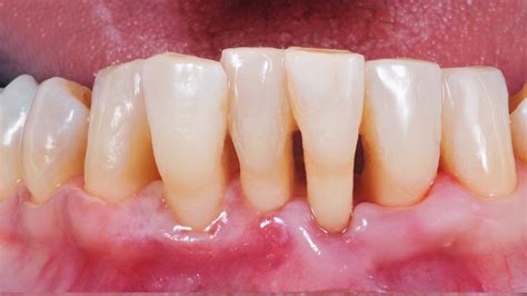 What Is Gum Recession And How To Treat It Brisbane Smiles
