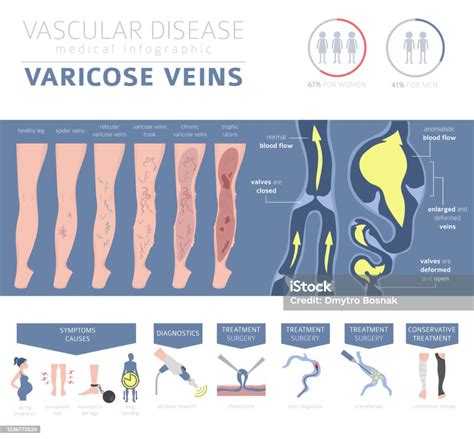 Vascular Diseases Varicose Veins Symptoms Treatment Icon Set Medical
