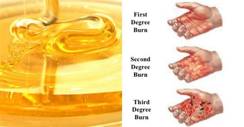 Never Ever Ice A Burn Try These Home Remedies For Minor Burns Instead