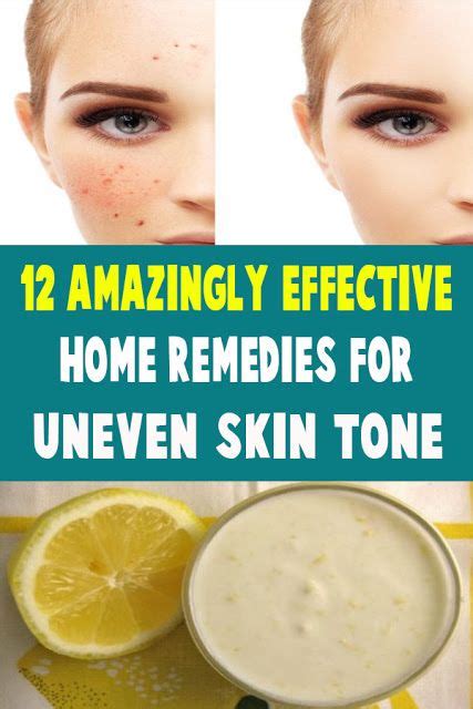 12 Amazingly Effective Home Remedies For Uneven Skin Tone In 2020