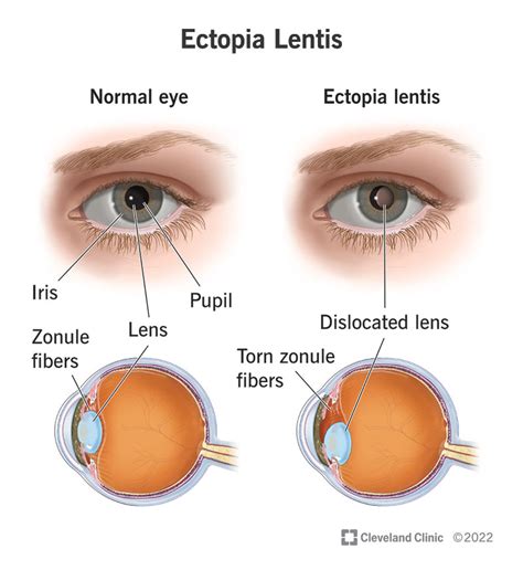 Ectopia Lentis What It Is Causes And Symptoms