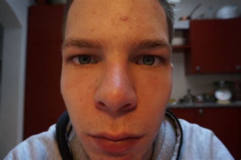 Acne New User With Acne Dry Skin And No Idea What To Do Any Help Is
