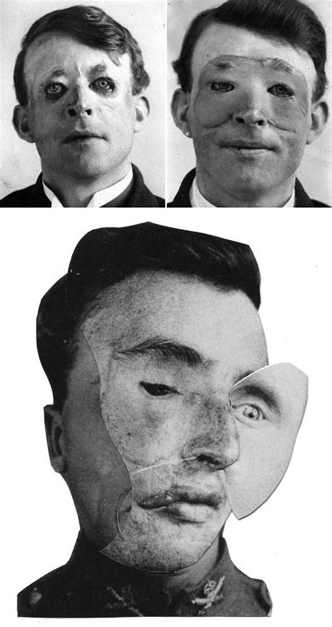 12 Best Plastic Surgery Of Ww1 Images On Pinterest World War One