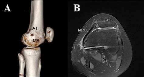 Figure 1 From Arthroscopic Medial Patellofemoral Ligament