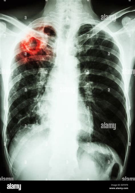 Pulmonary Tuberculosis Tb Chest Xray Show Stock Photo The Best Porn