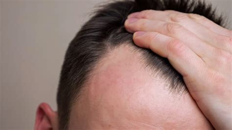 How To Regrow Hair On Bald Spot Fast Fact And Tips 2023