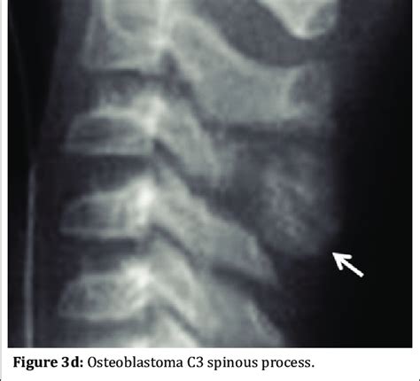 C Osteoblastoma Osteosarcoma Type Of L3 Download Scientific Diagram