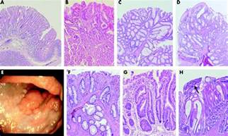 Mucosal Prolapse In The Pathogenesis Of Peutz Jeghers Polyposis Gut