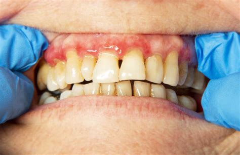 Periodontitis Symptoms Causes And Prevention Bright Horizons Dental