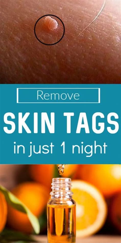 how to remove skin tags skin tags essential oils skin tag removal essential oils for skin