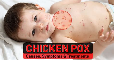 Chicken Pox Symptoms Causes And Treatment