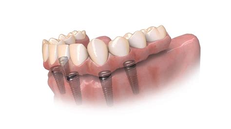 Hybridge Dental Implants Palmdale Ca Hybridge Dental Implants Cost