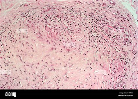 Leprosy Borderline Tuberculoid Leprosy Dermal Nerve Stock Photo Alamy