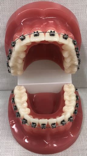 Different Parts Of Braces Orthodontic Terminology