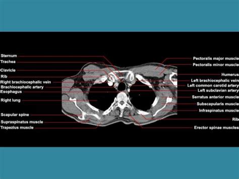 Back Muscles Anatomy Ct Chest Anatomy Mri Chest Thoraxaxial