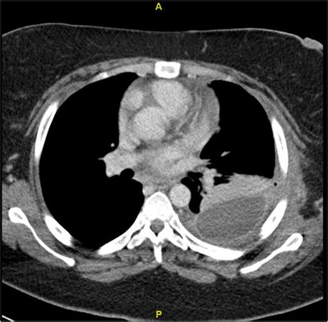 Ct Scan Showing A Loculated Pleural Effusion With Pleural Thickening
