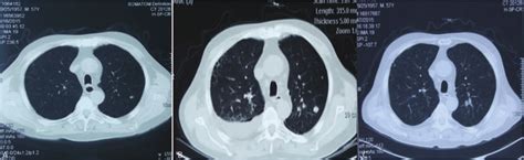 Chest Ct A Nodules In The Apicoposterior Segment Of The Left Upper