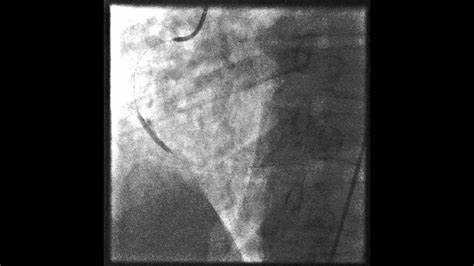 Инфаркт миокарда диета 10 Остър инфаркт на миокарда - YouTube Остър инфаркт на миокарда - YouTube Инфаркт миокарда диета 10