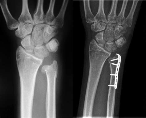 Distal Ulna Fractures Journal Of Hand Surgery