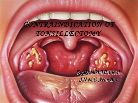 Contraindication Of Tonsillectomy