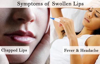 What Causes Dry Itchy Swollen Lips Infoupdate Org