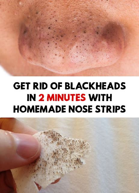 Get Rid Of Blackheads In 2 Minutes With Homemade Nose Strips Wellness