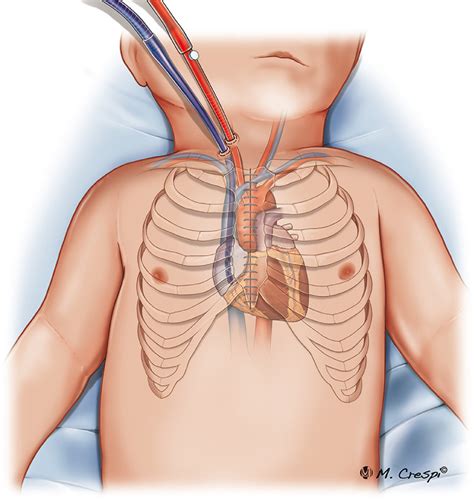 Structured Review Of Post Cardiotomy Extracorporeal Membrane Oxygenation Part 2—pediatric