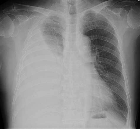 Tuberculous Pleural Effusion Respiratory Care