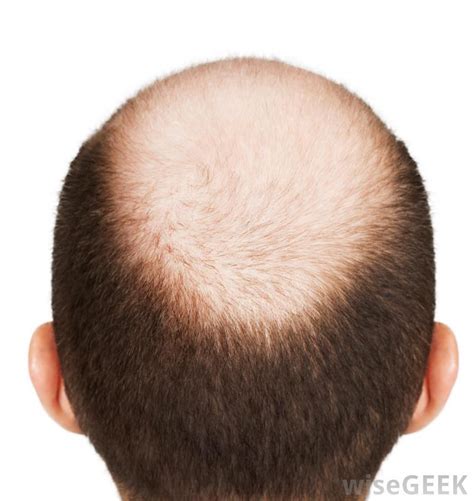The drug lowers the production of dihydrotestosterone, a male hormone blamed for hair loss. How Do I Use Ketoconazole for Hair Loss? (with pictures)