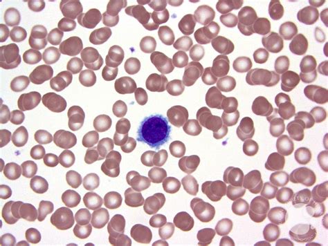 Hairy Cell Leukemia 3