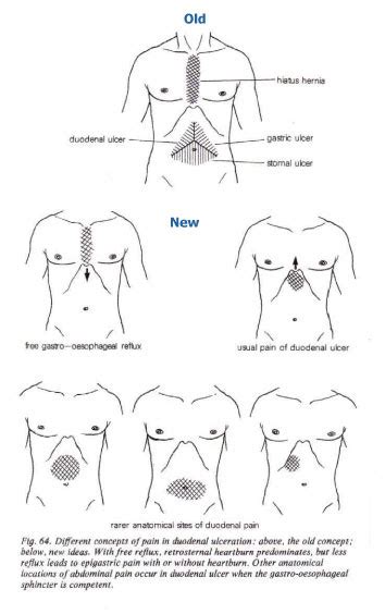 Kendell Blog Epigastric Pain