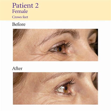Anti Wrinkle Injections Aesthetic Medicine