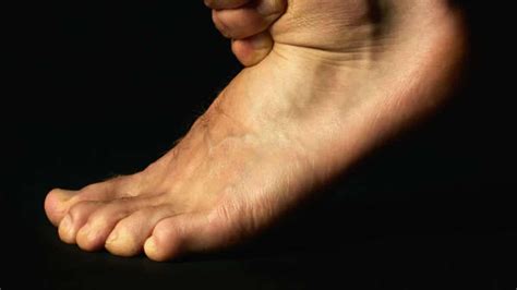 An injury where the big toe bends back too far aka metatarsophalangeal joint sprain. What is Turf Toe? - Premier Football UK
