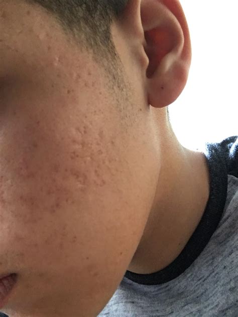 What Type Of Acne Scars Do I Have And Whats The Best Treatment In Your