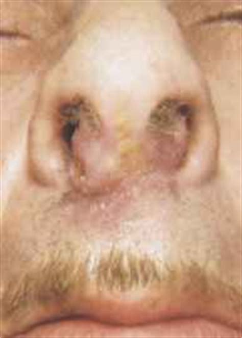 Nasal vestibulitis is the diffuse dermatitis of nasal vestibule. Malignant Nasal Tumors - Hearing Loss - Derick Mussen ...