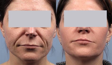 Before And After Spectralift Non Surgical Laser Facelift