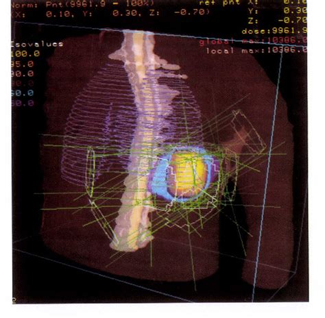 Figure I From Three Dimensional Conformal Radiation Therapy For Lung