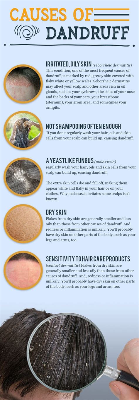 Discover What The Causes Of Dandruff Are Healthybeauty Causesof Dandruff Dandruff Healthy