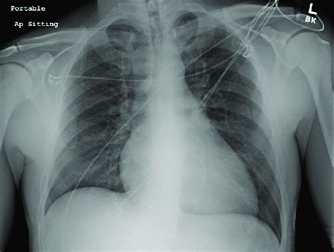 The Patients Chest Radiograph Showing A Borderline Enlarged Cardiac