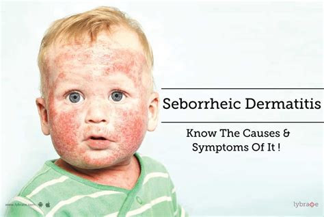 Seborrheic Dermatitis Know The Causes And Symptoms Of It By Dr