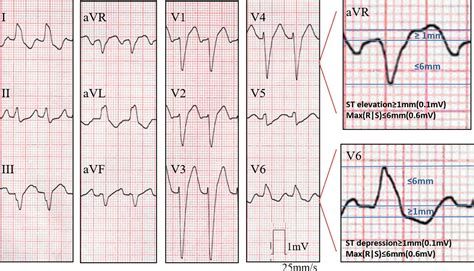 New Electrocardiographic Algorithm For The Diagnosis Of Acute